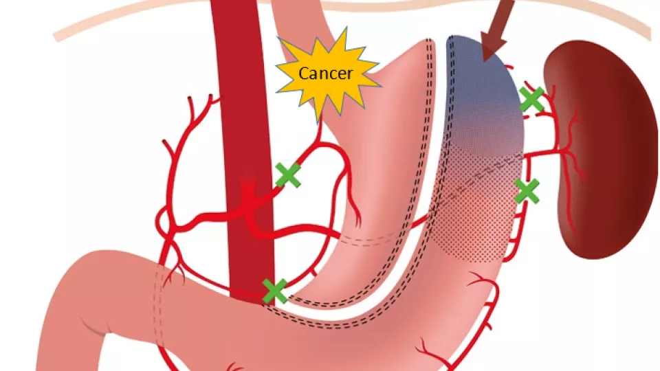 White background and different red blobs in the foreground. The word cancer is written on the red blob that corresponds to the stomach. Illustration.