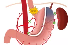 White background and different red blobs in the foreground. The word cancer is written on the red blob that corresponds to the stomach. Illustration.